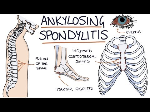 Ankylosing Spondylitis: Visual Explanation for Students