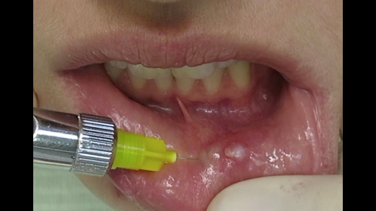 Удаление ретенционной кисты нижней губы