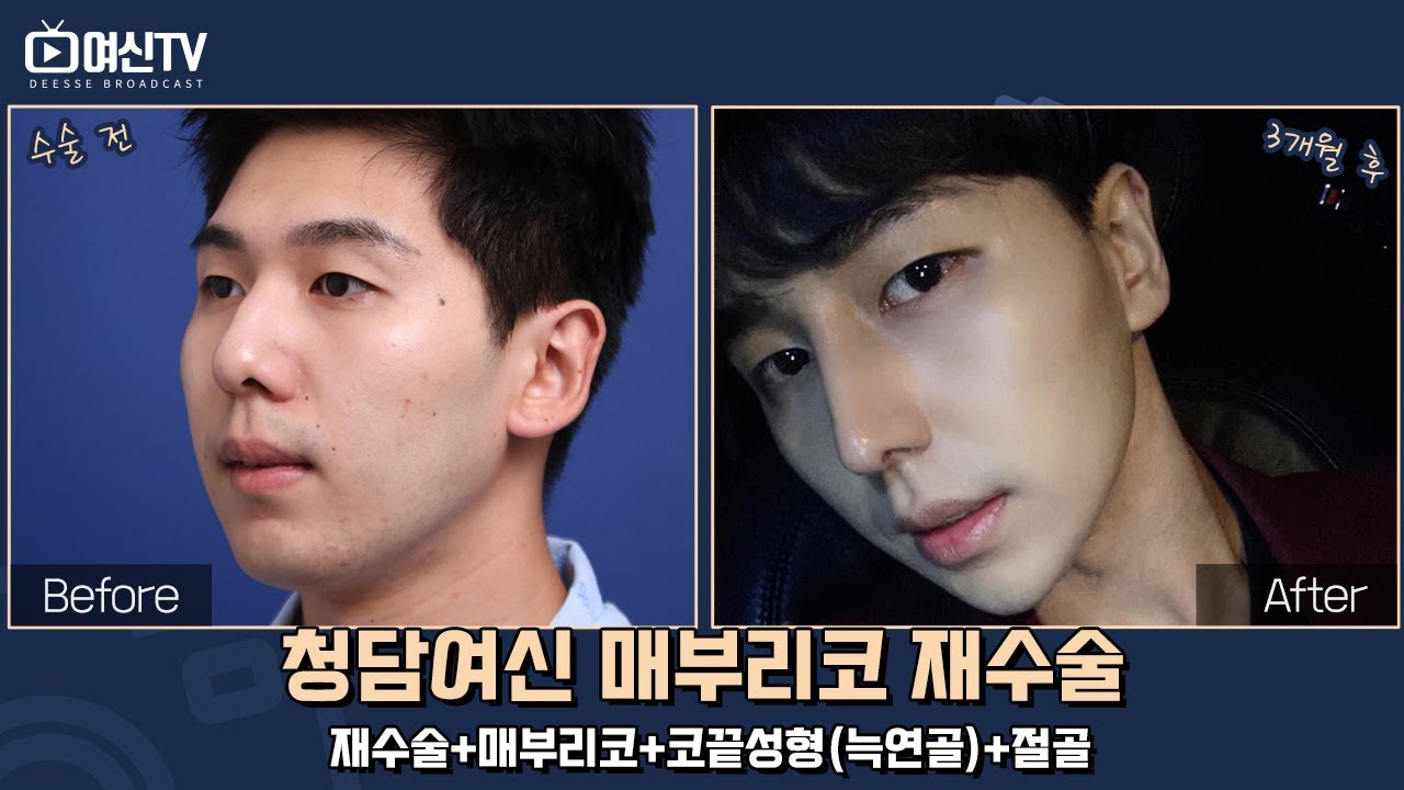 매부리코 성형 레전드 :: 과거는 잊고 재수술 후 여신 등극