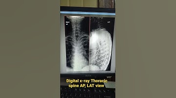 Digital X-Ray Thoracic spine AP, LAT view#thoracicsurgery #spine #thoracicspine#digitalxray #digital