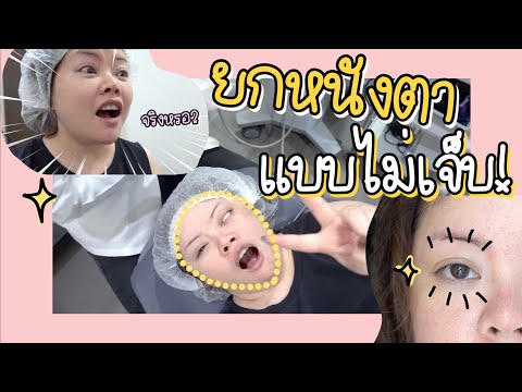 รีวิวหลังจากไปยกหนังตาแบบไม่เจ็บมา 3 เดือน โปรแกรม Fox eyes lift ที่ The Klinique  | FEONALITA