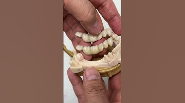 6-Unit Ceramic Bridge @EnvisiontecMain #envisiontec