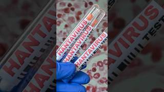 Do We Need a Hantavirus Vaccine?