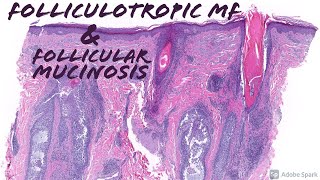 Folliculotropic Mycosis Fungoides (Cutaneous T-cell Lymphoma) & Follicular Mucinosis
