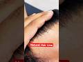 180 - Days Hair Transplant Result Khandwa Khargone #youtubeshorts #viral #hairtransplant #trending