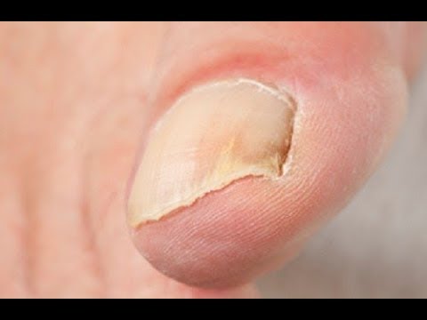 Vidéo: Ongles Qui Poussent Vers Le Haut: Causes Et Traitements à Domicile