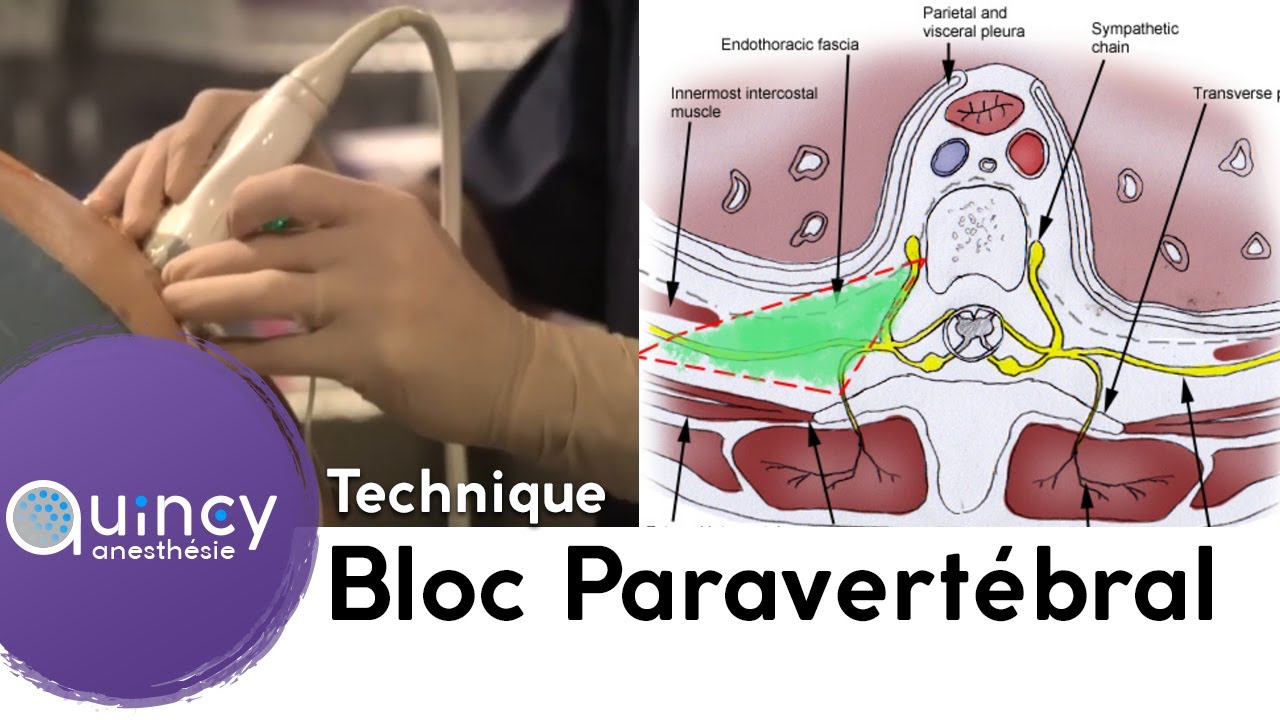 Bloc Paravertébral - Quincy Anesthésie