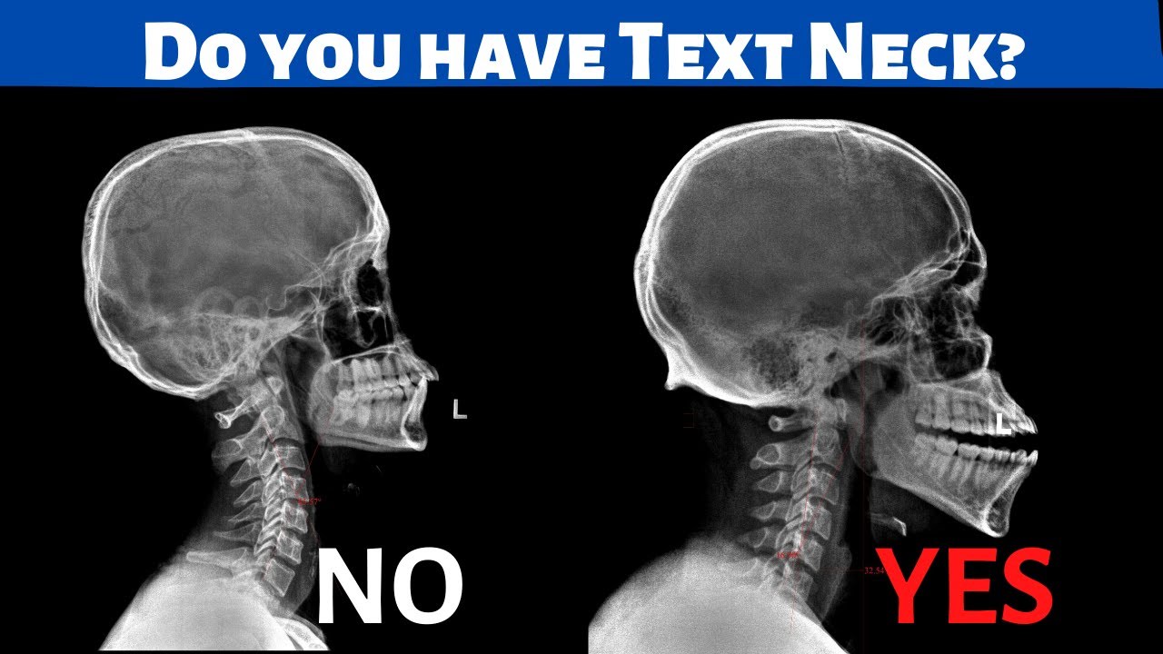 Is your Neck Pain or Back Pain due to Text Neck? *Find out!*