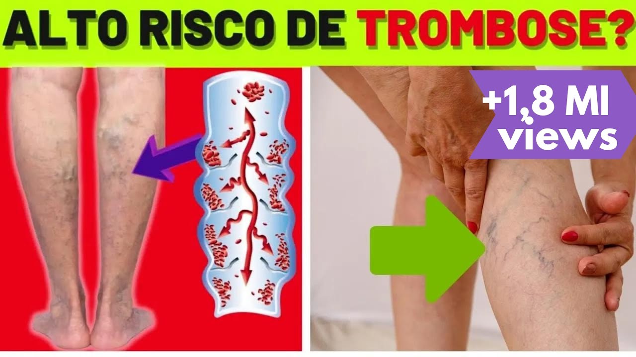 COMO MELHORAR a CIRCULAÇÃO e SE LIVRAR das VARIZES NAS PERNAS (e evitar trombose)