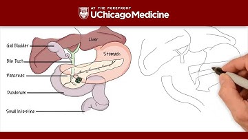 What is the Whipple procedure? - UChicago Medicine