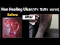 नॉन हीलिंग अल्सर I Non Healing Alcer