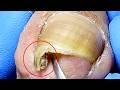 The Sharp Ingrown Toenails Are Very Prominent, So Cut Them Cleanly【Xue Yidao】