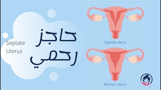 Intrauterine Septum Endoscope حاجز رحمي