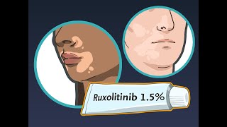 Ruxolitinib Cream for Vitiligo | NEJM screenshot 1