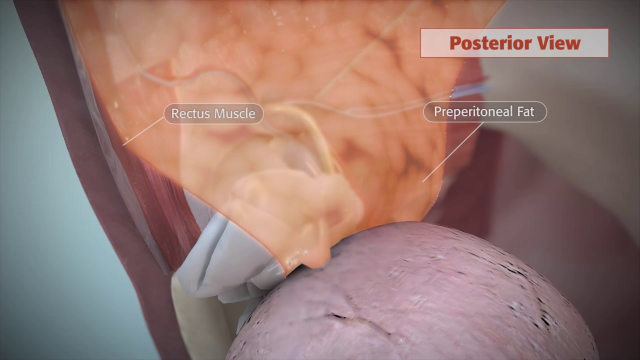 Polysoft Методика ONStep