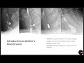 Zenkers diverticulum explained symptoms diagnosis and treatment  med madness