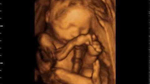 3d/4d Ultrasound AT 23 Weeks from GoldenView Ultrasound