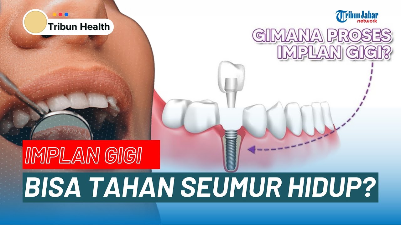 Implan Gigi Dapat Membuat Wajah Tampak Lebih Muda? | TRIBUN HEALTH