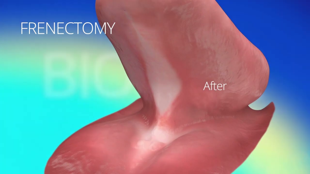 Waterlase  Laser Dentistry Patient Videos