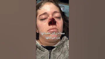 عضة كلب تتسبب بنمو شعر على أنف فتاة 