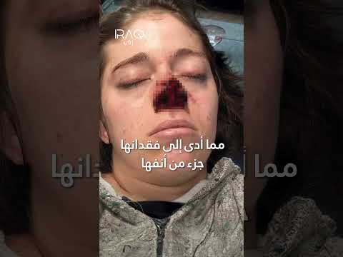 عضة كلب تتسبب بنمو شعر على أنف فتاة