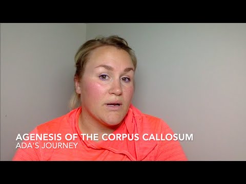 Video: Corpus Callosum, Agenesis: Årsager, Symptomer Og Behandling