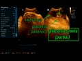 Placenta previa || ultrasound findings