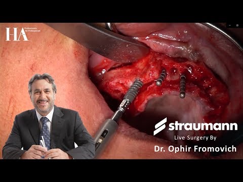Straumann BLX Live surgery (Short version) - Dr. Ophir Fromovich at Tel Aviv university