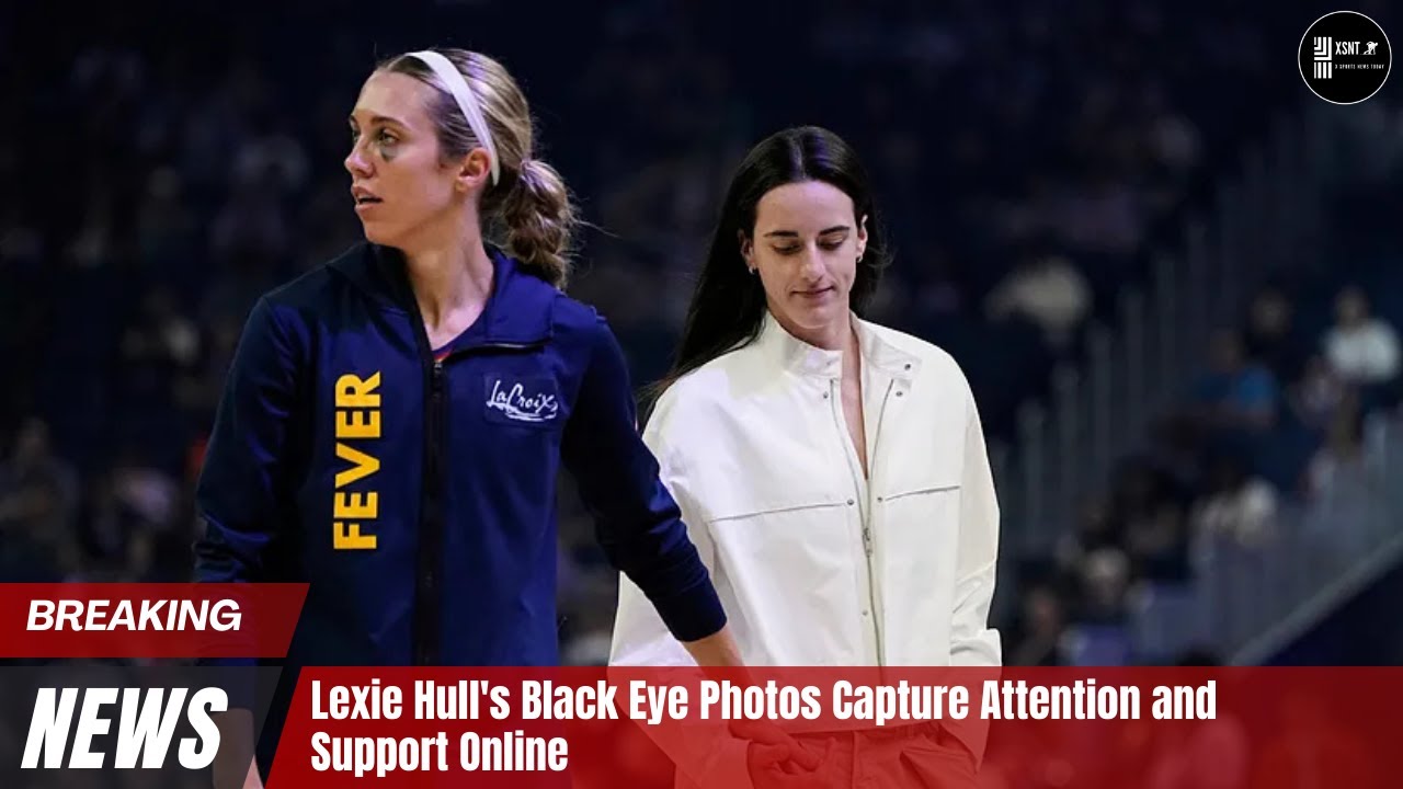 Lexie Hull's Black Eye Photos Capture Attention and Support Online 