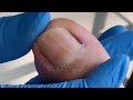 Pedicure tutorial: long-term patients suffering from ingrown nails【Xue Yidao】