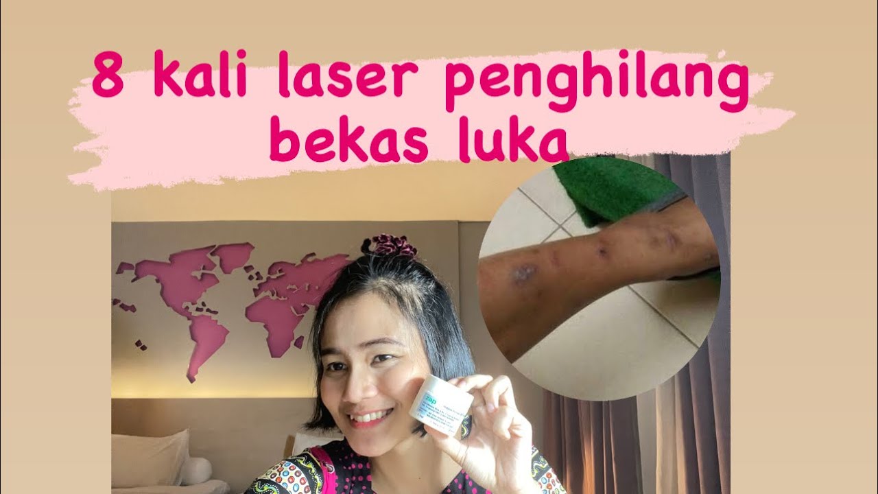 Sharing Perjuangan Pramugari menghilangkan Bekas Luka