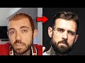 How Adam22 Reversed His Hair Loss