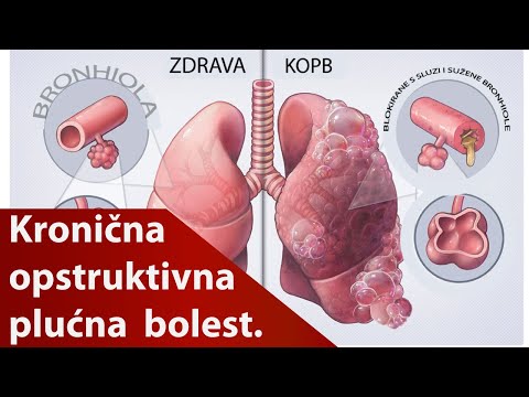 Video: KOPB Bolest (kronična Opstruktivna Plućna Bolest) - Uzroci, Simptomi, Stadiji, Dijagnoza, Liječenje I Prevencija