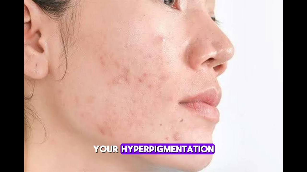 how to clear your hyperpigmentation