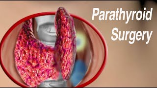 Parathyroid Surgery: Traditional Open and Minimally Invasive Approaches