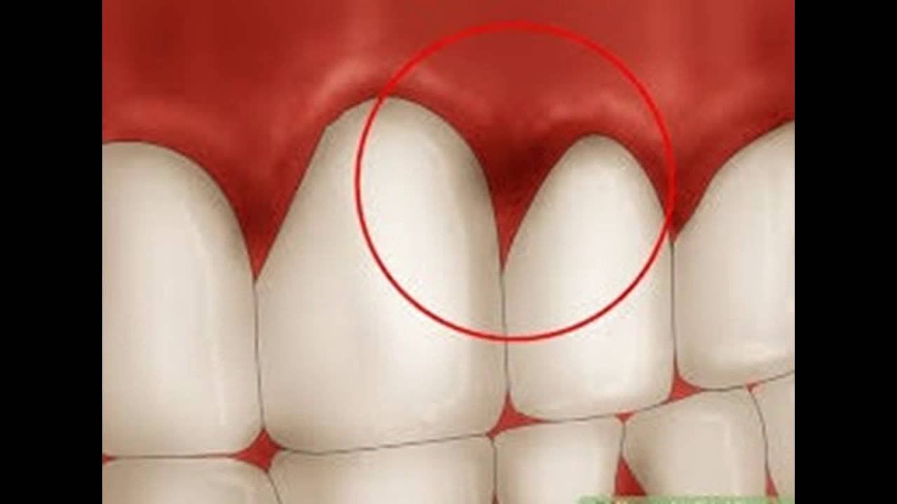 Comment se débarrasser de la gingivite - YouTube