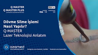 Dövme Silme İşlemi Nasıl Yapılır? Q-Master Lazer Teknolojisi Anlatım