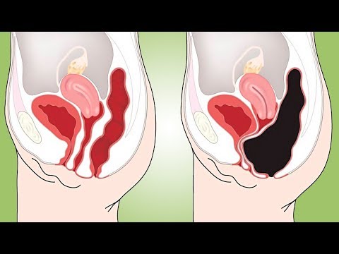 How to Cleanse Your Colon Naturally at Home (Colon Cleanse Smoothie)