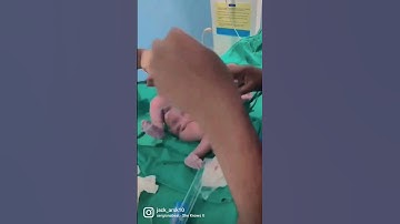 Thumbnail of lscs ... baby girl 2.8 kg Kingston hospital 🏥 ... plz subscribe and like 🙏
