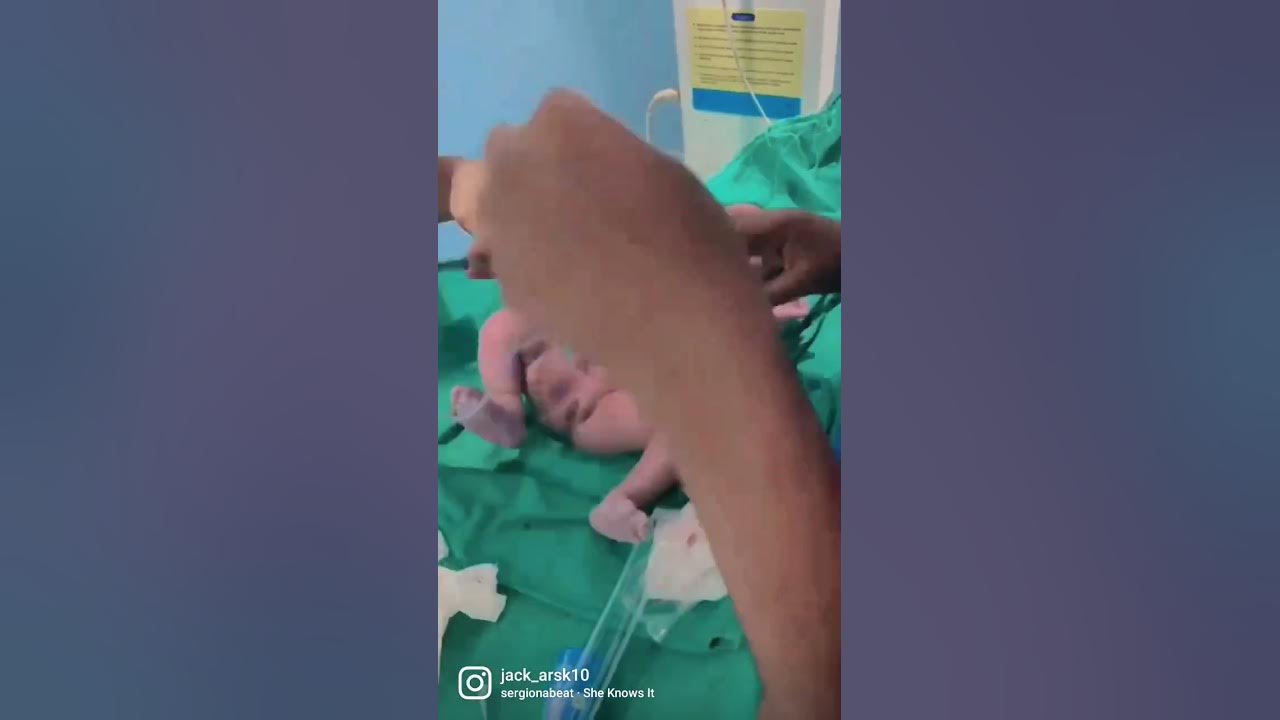 lscs ... baby girl 2.8 kg Kingston hospital 🏥 ... plz subscribe and like 🙏