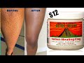 How to get rid of strawberry legs in 3days.
