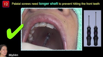 Newly released: OBS Blade-L｜【Chris Chang Ortho】CC494