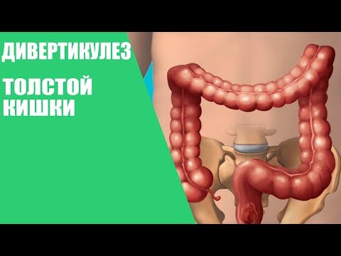 Дивертикулез толстой кишки/Симптомы