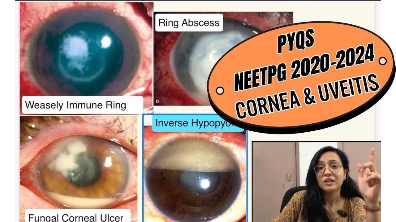 PYQs Ophthalmology | NEET PG 2020-24 | Cornea & Uveitis