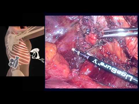 Video-assisted thoracoscopic extrapleural pneumonectomy for malignant pleural mesothelioma Hqdefault