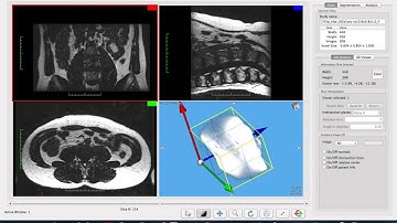 Basic Navigation for iSix Plugin in Osirix