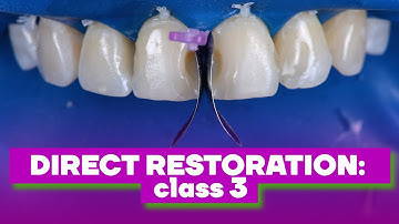Direct restoration: class 3  | BG Dental Cases #31