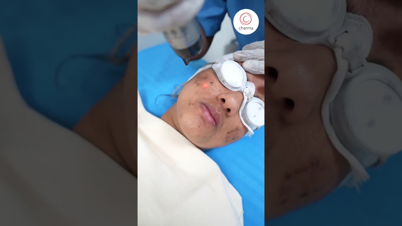 How Laser Toning Treatment Can Transform Your Acne Spots? – Charma Clinic