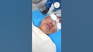 How Laser Toning Treatment Can Transform Your Acne Spots? - Charma Clinic
