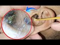 WARNING: Deep, Infected Earwax Extraction! | Dry &amp; Crusty ASMR Ear Cleaning | EP 70